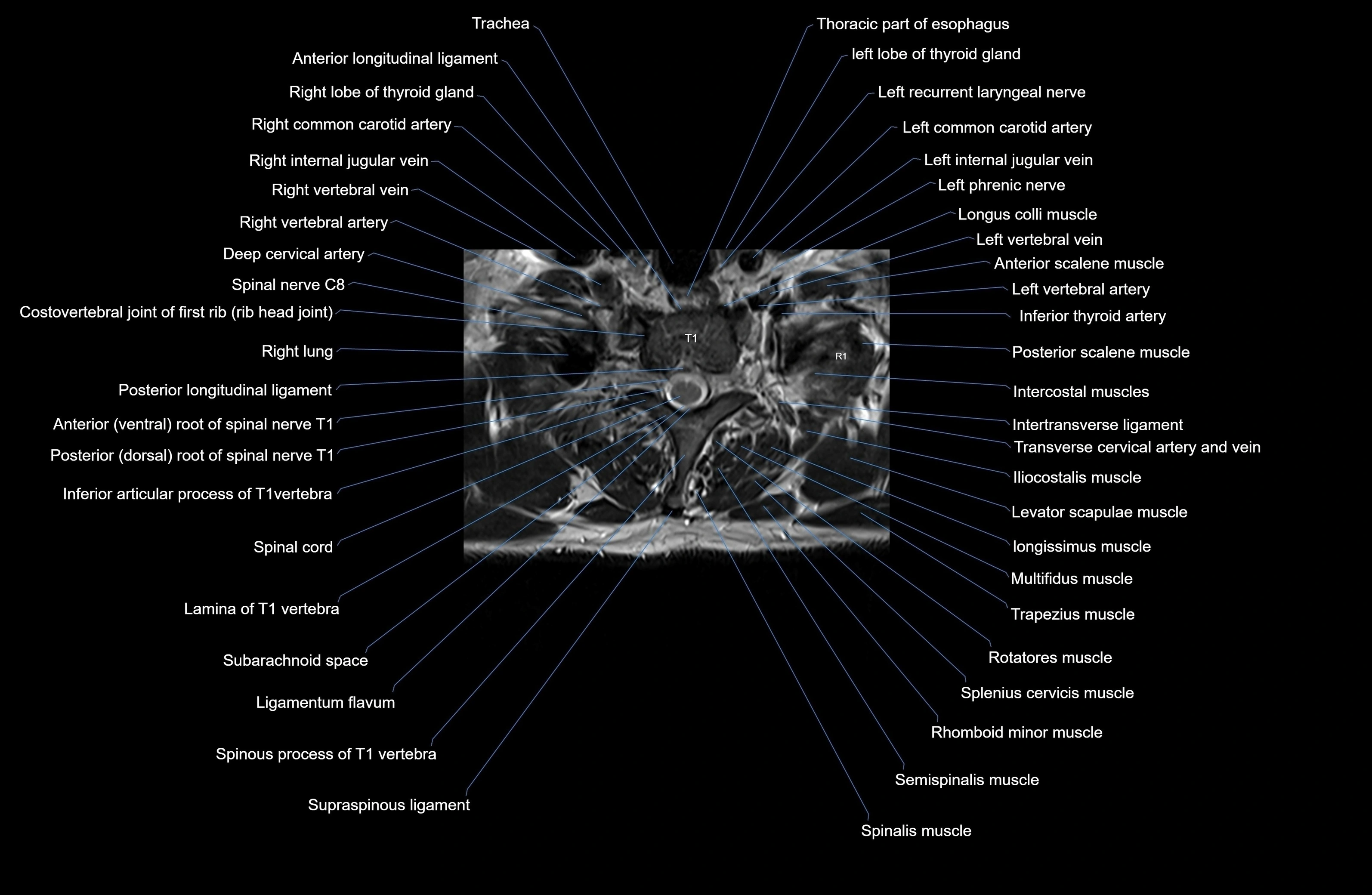 MRI thoracic spine axial  cross sectional anatomy 3T radiology  image-img-00001-00009.webp